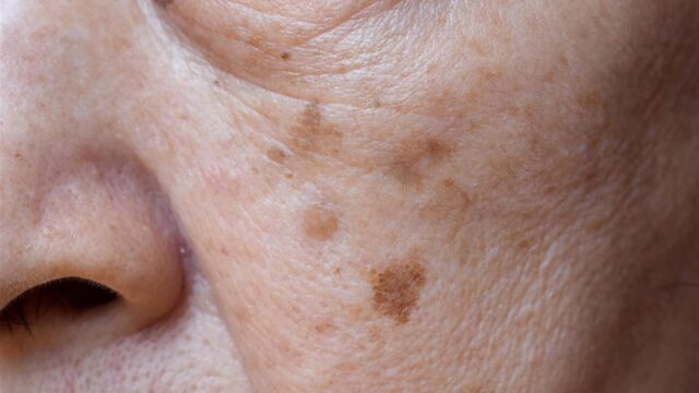 Age Spots - Small brown patches called age spots on face of an elderly woman. They are also called liver spots, senile lentigo, or sun spots.