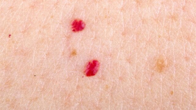 Cherry Angiomas - Cherry angioma removal available in Fareham by Dermatouch