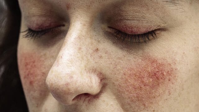 Rosacea - Deramtouch treats conditions like this