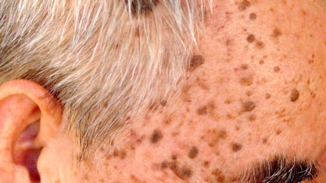 Senile Warts - Dermatouch can help to reduce the appearance of these