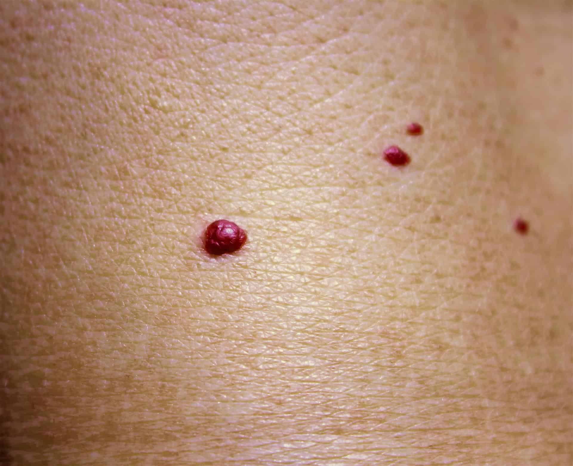 Cherry Angioma Removal Fareham Dermatouch Skin Clinic Cherry Angioma Removal Fareham Dermatouch Skin Clinic
